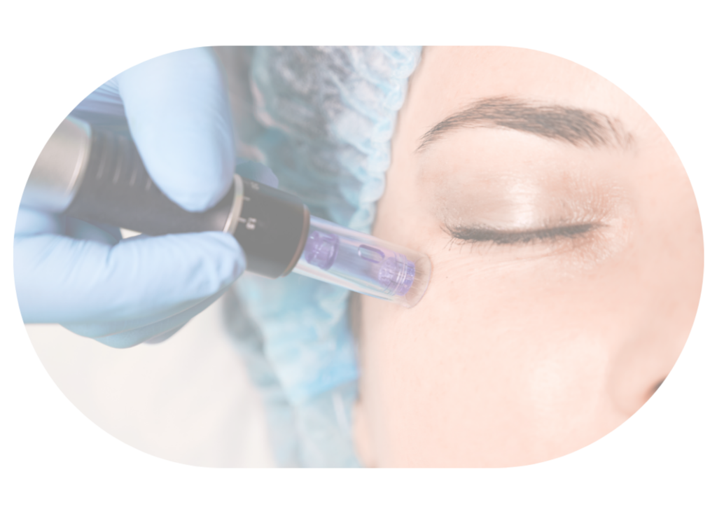 POG Kleinmond Micro needling